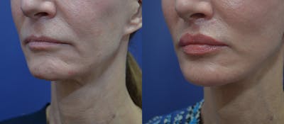 Lip Lift Before & After Gallery - Patient 23053128 - Image 2