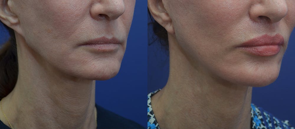 Lip Lift Before & After Gallery - Patient 23053128 - Image 3