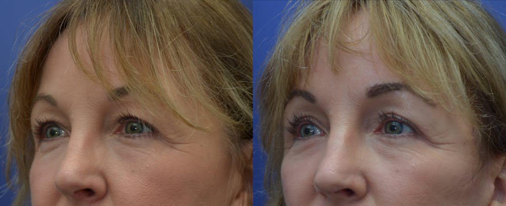 Eyelid Surgery Before & After Gallery - Patient 53271995 - Image 1