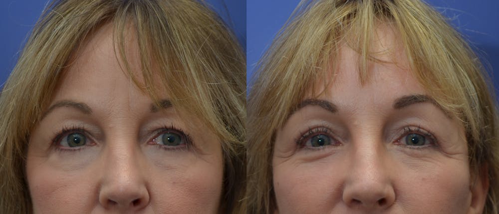Eyelid Surgery Before & After Gallery - Patient 53271995 - Image 2