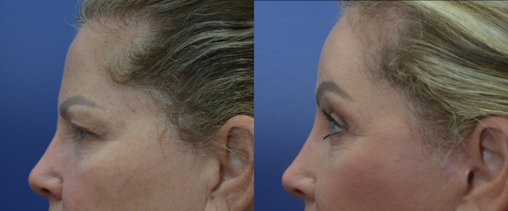 Brow Lift (Forehead Lift) Gallery - Patient 53277124 - Image 3