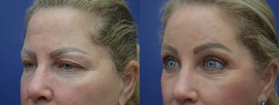 Brow Lift (Forehead Lift) Before & After Gallery - Patient 53277124 - Image 2