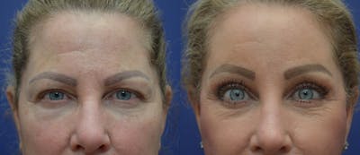 Brow Lift (Forehead Lift) Before & After Gallery - Patient 53277124 - Image 1