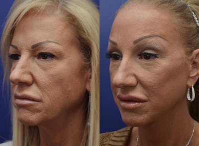 Deep Plane Facelift Before & After Gallery - Patient 4588112 - Image 1