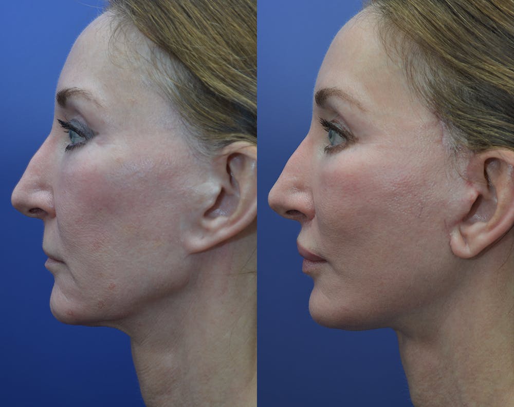 Facelift Before & After Gallery - Patient 25732381 - Image 2
