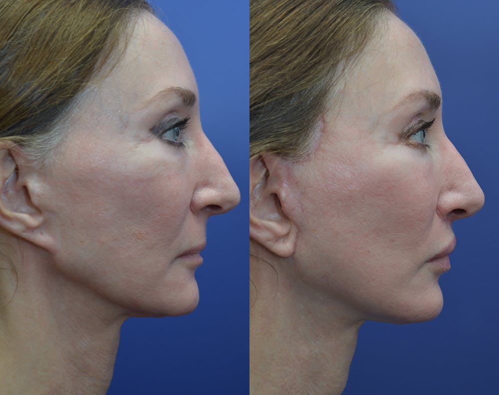 Deep Plane Facelift Before & After Gallery - Patient 25732381 - Image 4