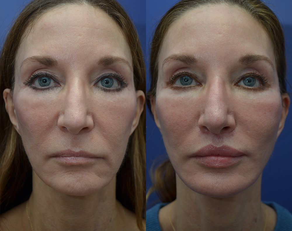 Patient 25732381 | Facelift Gallery | Tansavatdi Facial Plastic
