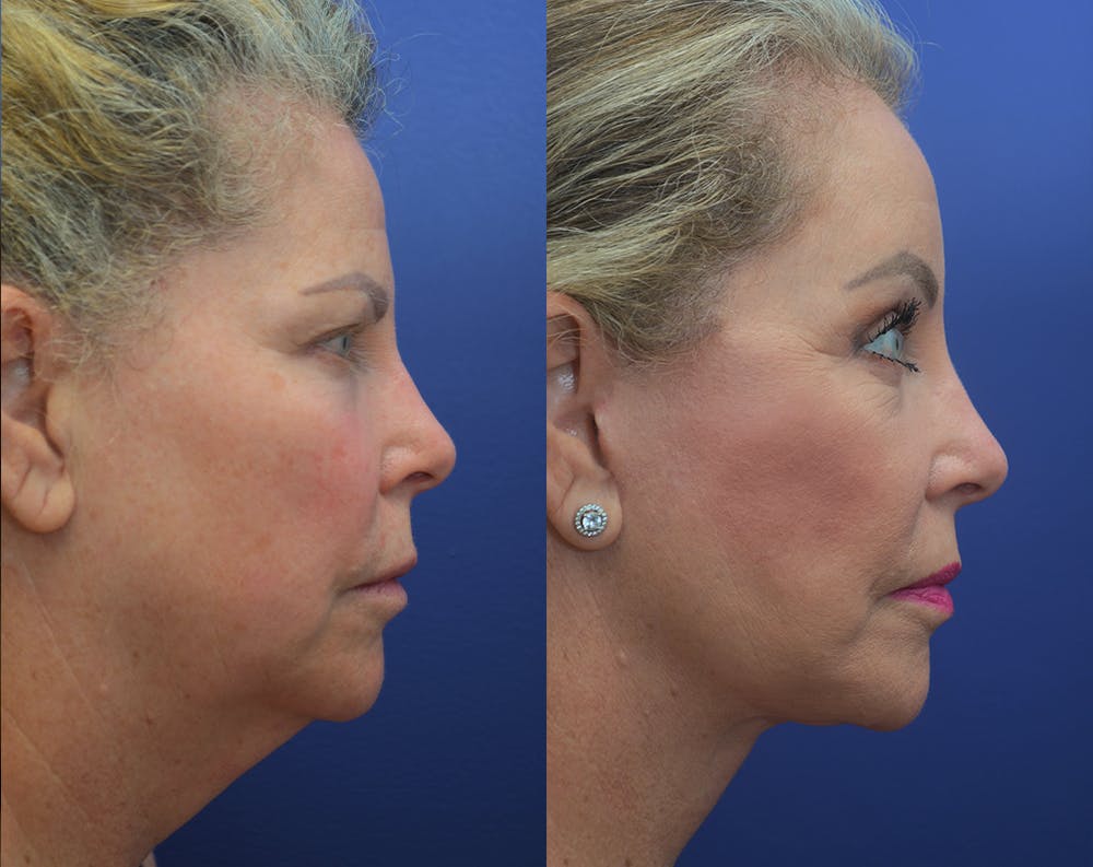 Deep Plane Neck Lift Before & After Gallery - Patient 50993114 - Image 1