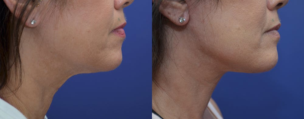Deep Plane Neck Lift Before & After Gallery - Patient 5930610 - Image 5