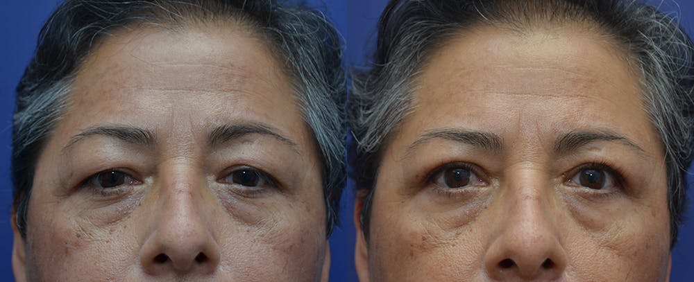 Brow Lift (Forehead Lift) Before & After Gallery - Patient 57582044 - Image 1