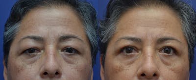 Brow Lift (Forehead Lift) Gallery - Patient 57582044 - Image 1