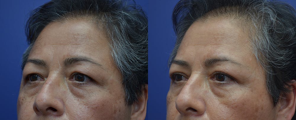 Brow Lift (Forehead Lift) Before & After Gallery - Patient 57582044 - Image 2