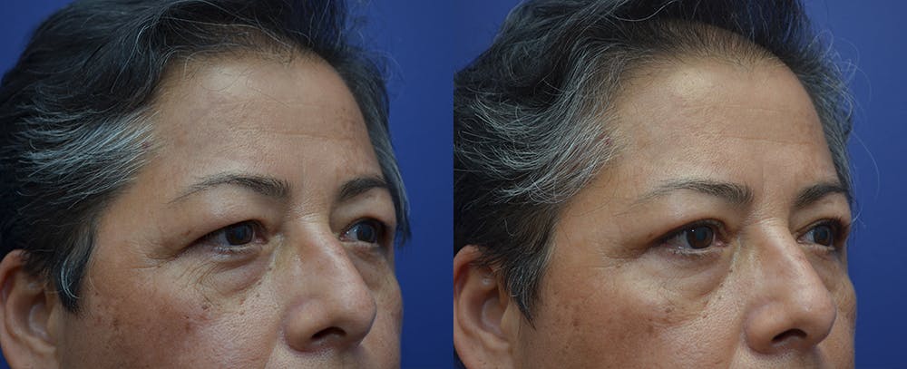 Brow Lift (Forehead Lift) Before & After Gallery - Patient 57582044 - Image 3