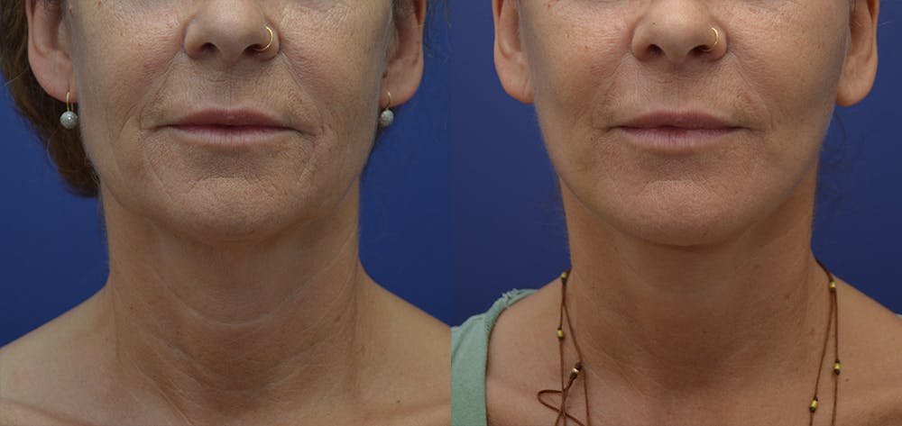 Deep Plane Neck Lift Before & After Gallery - Patient 57582129 - Image 2