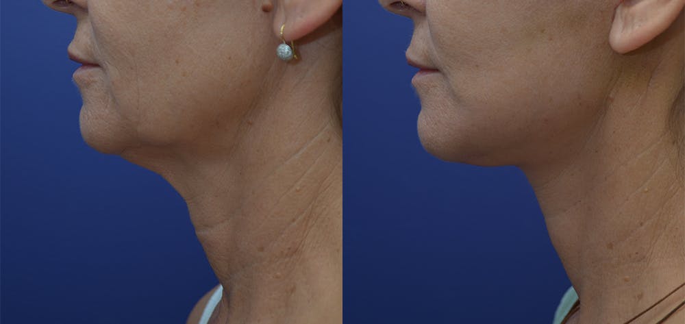 Deep Plane Neck Lift Before & After Gallery - Patient 57582129 - Image 1