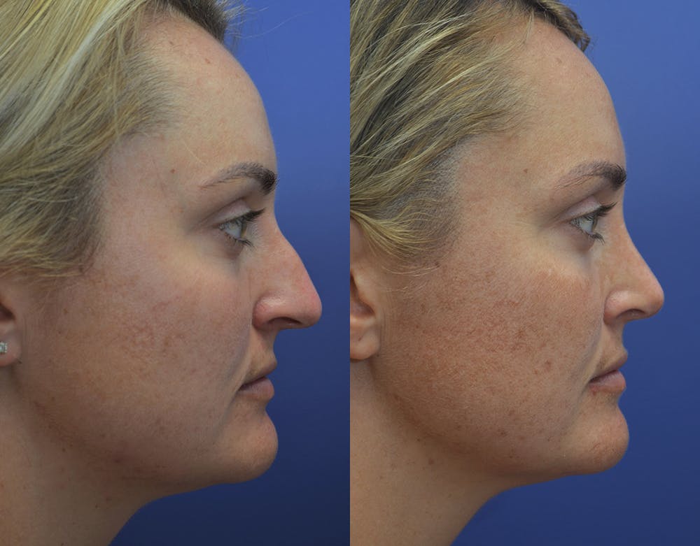 Rhinoplasty (Nose Reshaping) Before & After Gallery - Patient 5724943 - Image 5