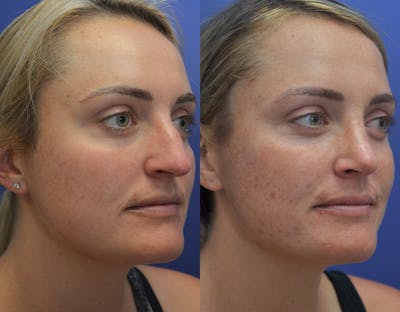 Rhinoplasty (Nose Reshaping) Before & After Gallery - Patient 5724943 - Image 4