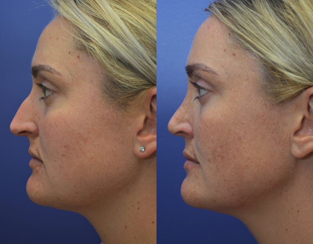 Rhinoplasty (Nose Reshaping) Before & After Gallery - Patient 5724943 - Image 3