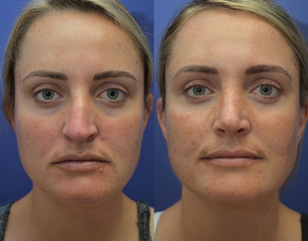 Rhinoplasty (Nose Reshaping) Before & After Gallery - Patient 5724943 - Image 1