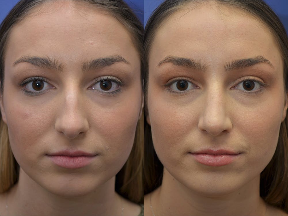 Rhinoplasty (Nose Reshaping) Before & After Gallery - Patient 5724935 - Image 3