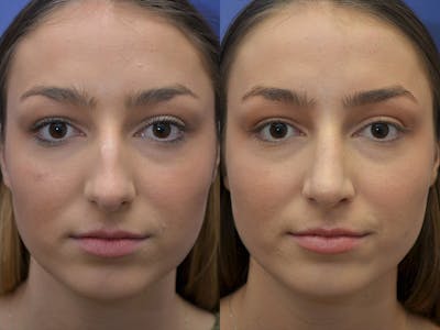 Rhinoplasty (Nose Reshaping) Before & After Gallery - Patient 5724935 - Image 1