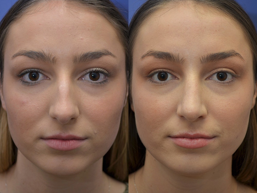 rhinoplasty before and after image 2