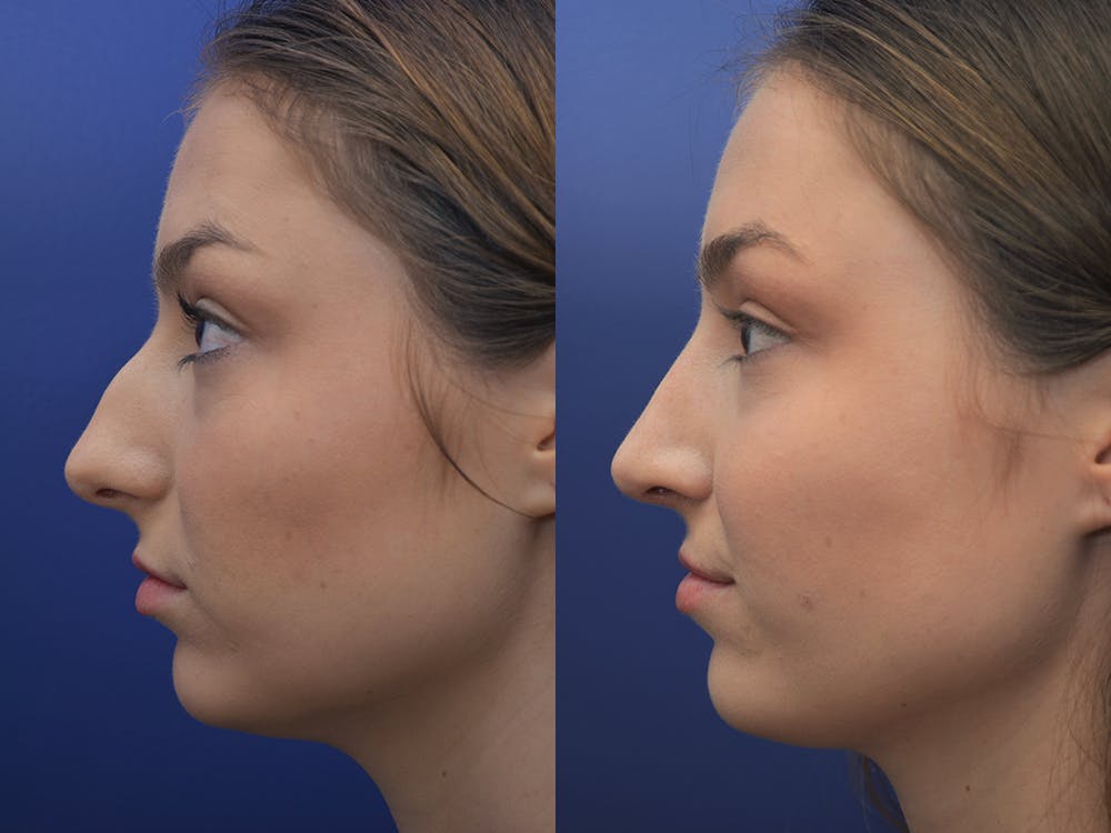 Rhinoplasty (Nose Reshaping) Before & After Gallery - Patient 5724935 - Image 3