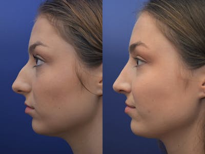 Rhinoplasty (Nose Reshaping) Before & After Gallery - Patient 5724935 - Image 2