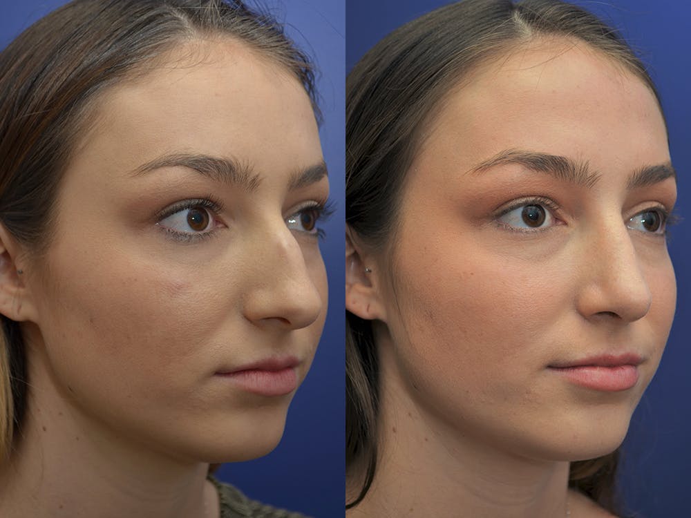 Rhinoplasty (Nose Reshaping) Before & After Gallery - Patient 5724935 - Image 4