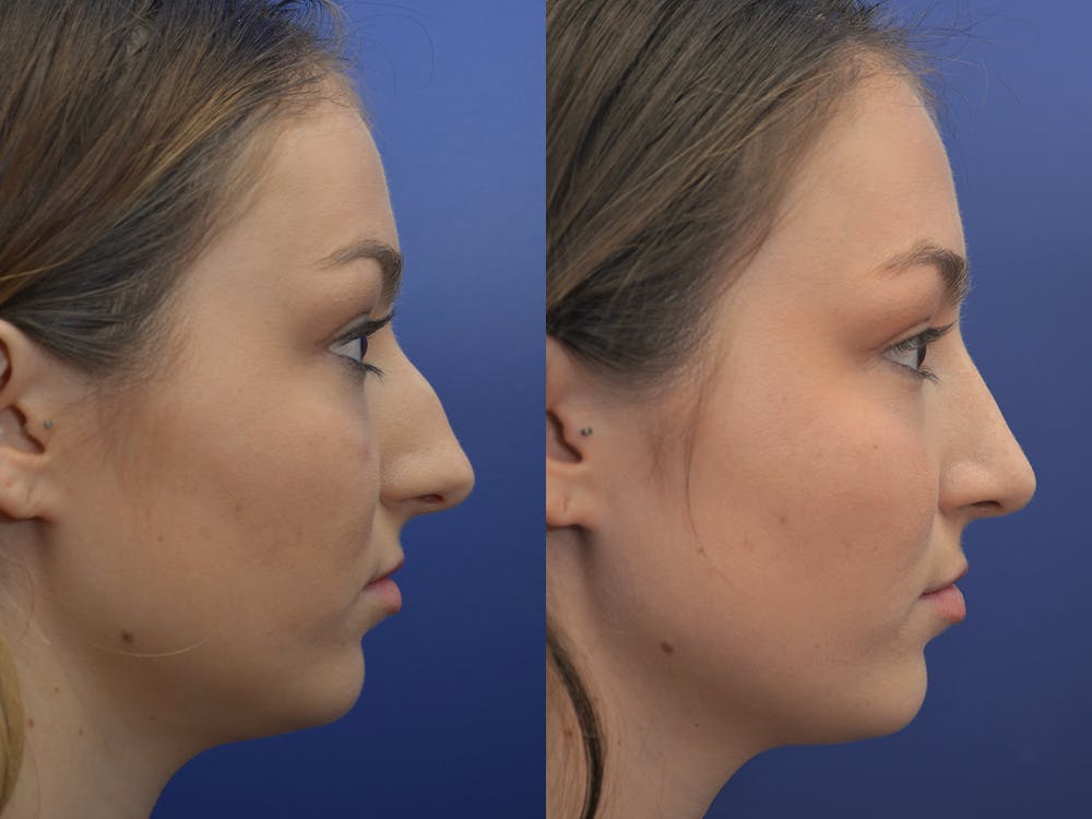 Rhinoplasty (Nose Reshaping) Before & After Gallery - Patient 5724935 - Image 5