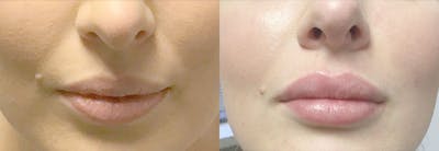 Lip Enhancement Before & After Gallery - Patient 68848502 - Image 1