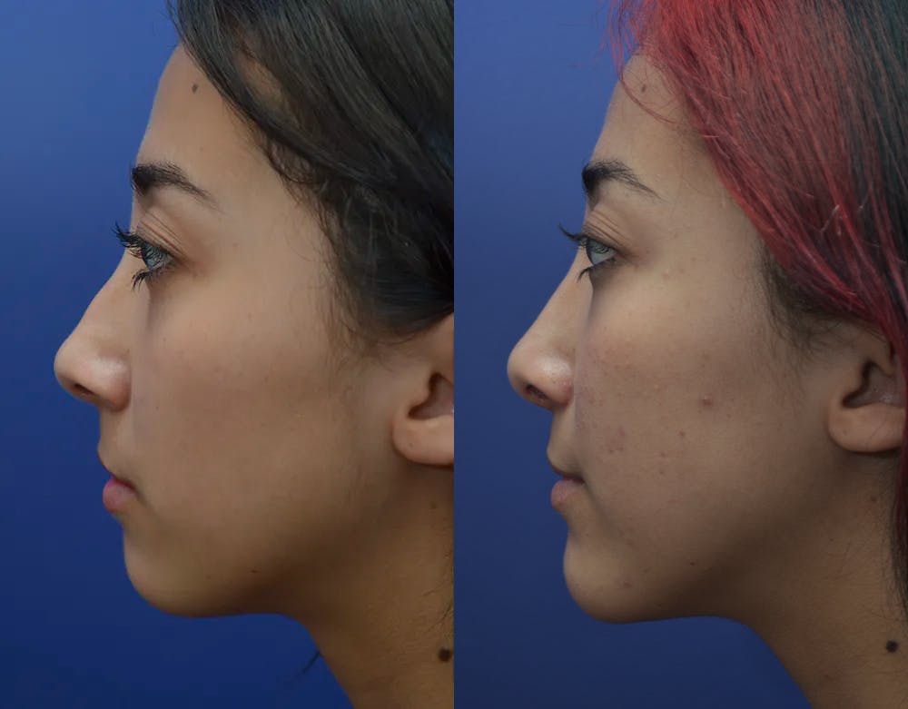 Rhinoplasty (Nose Reshaping) Gallery - Patient 19339358 - Image 2