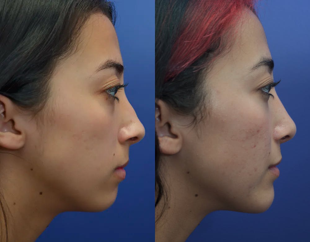 Rhinoplasty (Nose Reshaping) Before & After Gallery - Patient 19339358 - Image 4