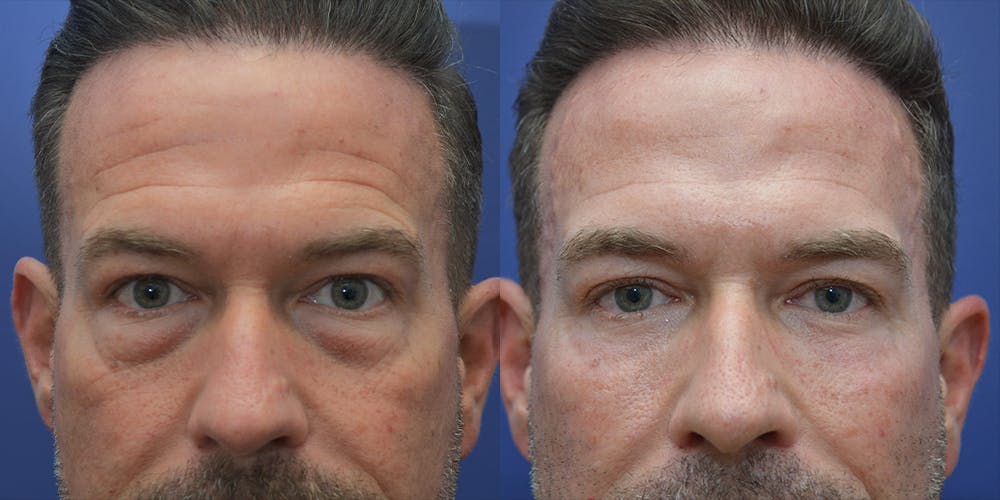 Eyelid Surgery Before & After Gallery - Patient 42516230 - Image 1
