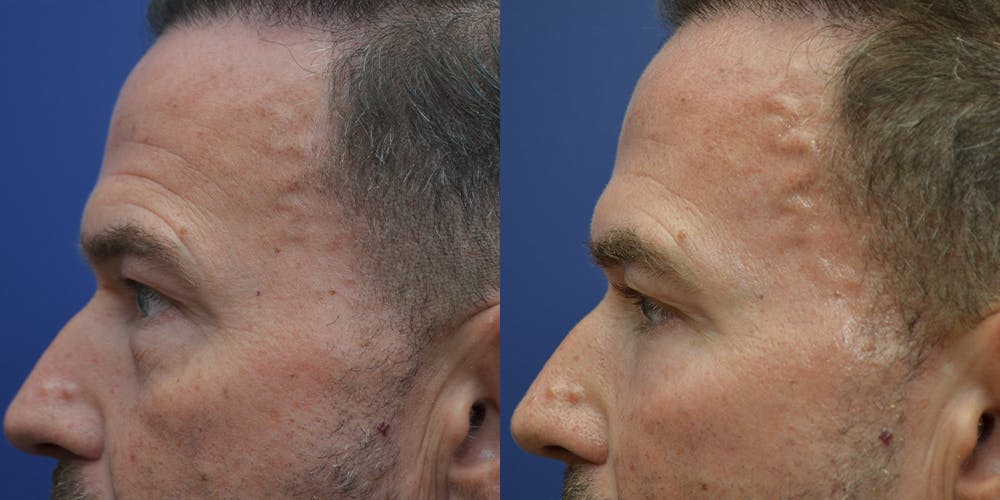 Eyelid Surgery Before & After Gallery - Patient 42516230 - Image 3
