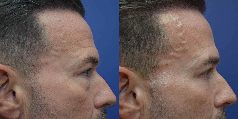 Dermabrasion / Chemical Peel Before & After Gallery - Patient 42516495 - Image 5
