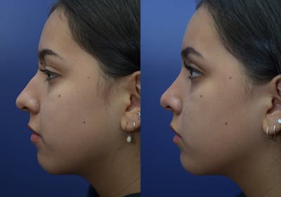Rhinoplasty (Nose Reshaping) Before & After Gallery - Patient 80448734 - Image 2