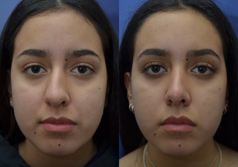 Rhinoplasty (Nose Reshaping) Gallery - Patient 80448734 - Image 5