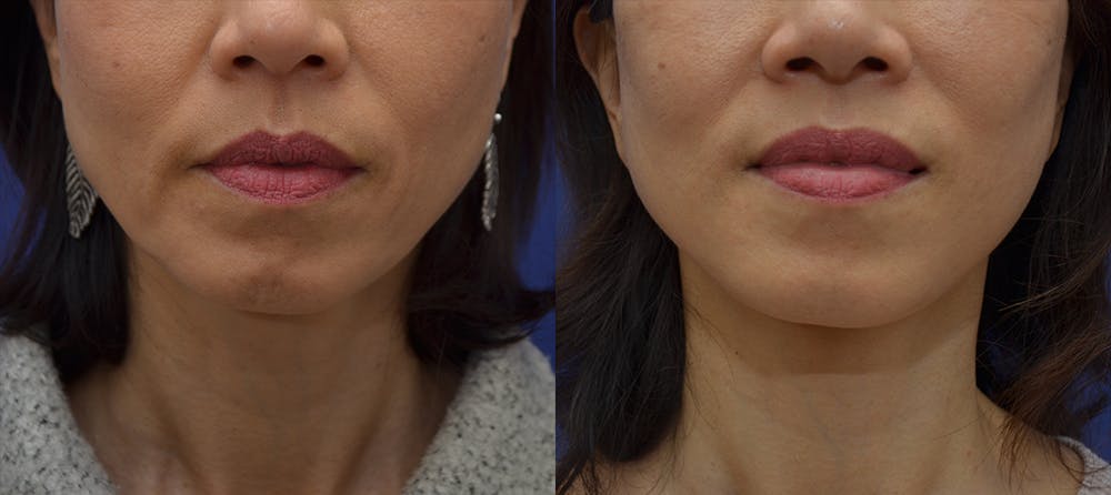 Deep Plane Neck Lift Before & After Gallery - Patient 80448797 - Image 1