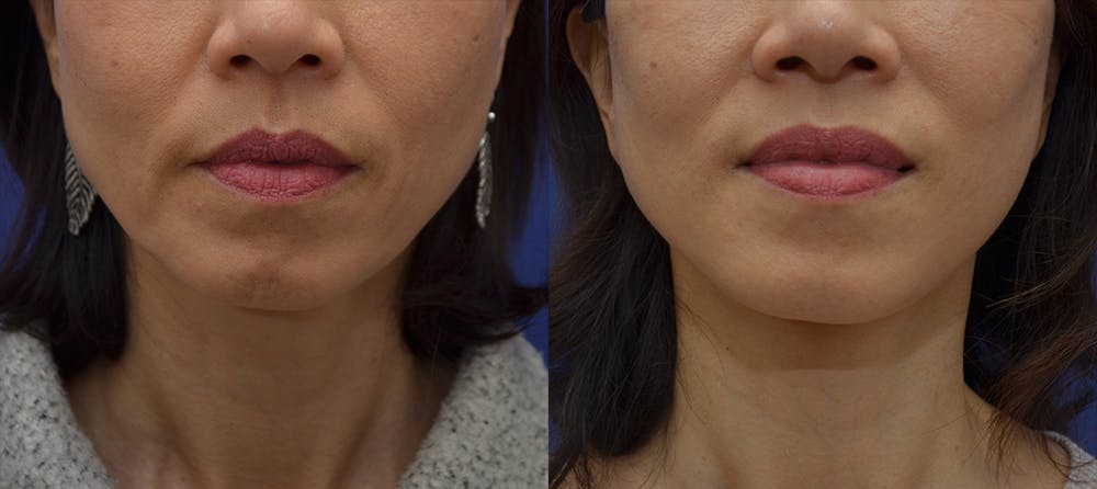 Facelift Before & After Gallery - Patient 80448795 - Image 1