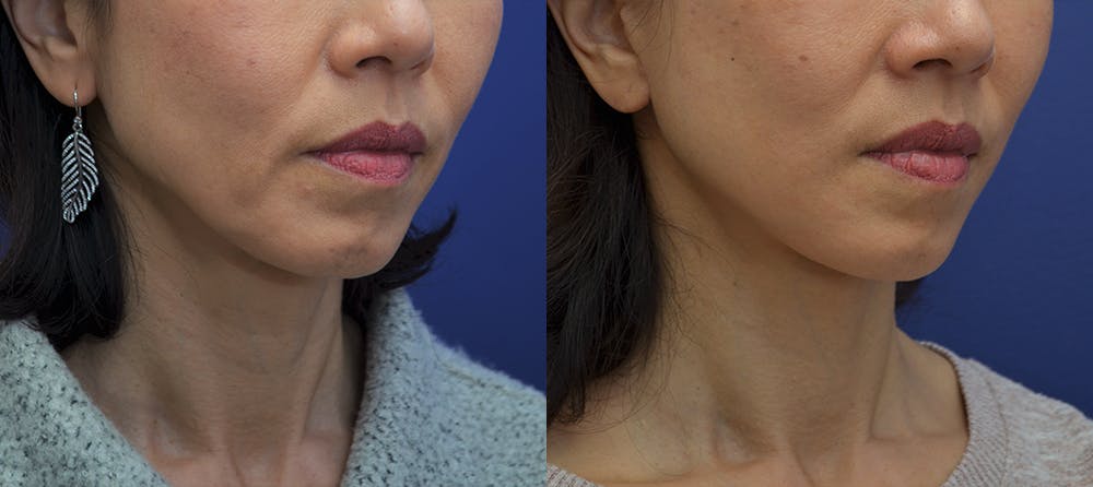 Deep Plane Neck Lift Before & After Gallery - Patient 80448797 - Image 2