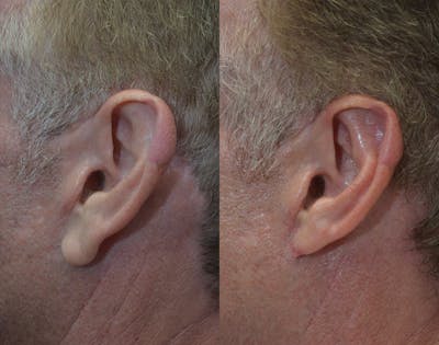Ear Reshaping (Otoplasty) Gallery - Patient 80448833 - Image 1