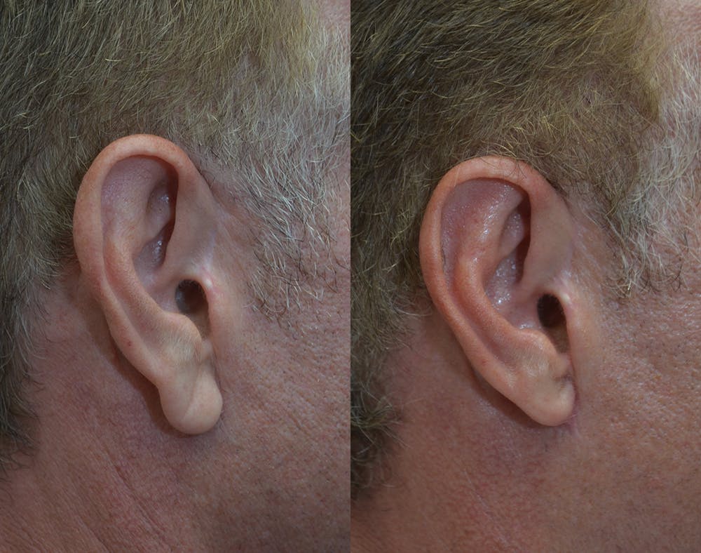 Ear Reshaping (Otoplasty) Gallery - Patient 80448833 - Image 2