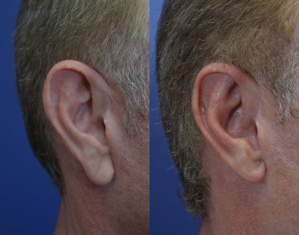 Ear Reshaping (Otoplasty) Gallery - Patient 80448833 - Image 3