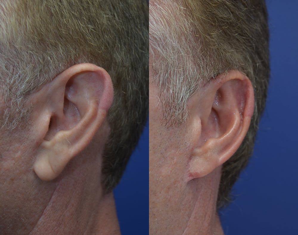 Ear Reshaping (Otoplasty) Gallery - Patient 80448833 - Image 4