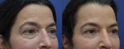 Eyelid Surgery Before & After Gallery - Patient 57580814 - Image 2