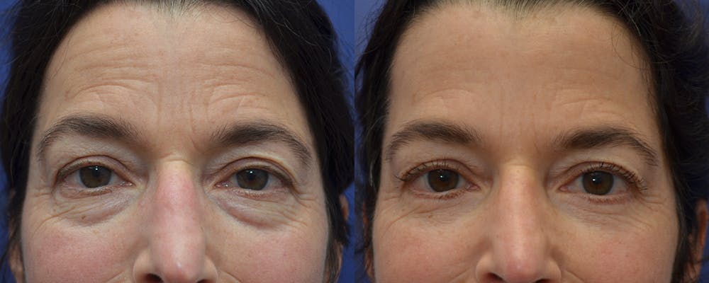 Eyelid Surgery Before & After Gallery - Patient 57580814 - Image 3