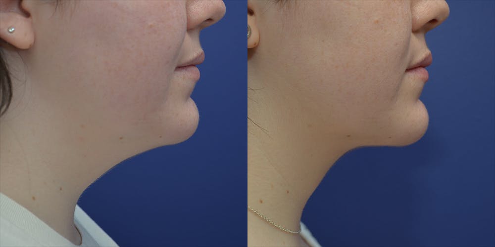 Liposuction Before & After Gallery - Patient 80448945 - Image 1