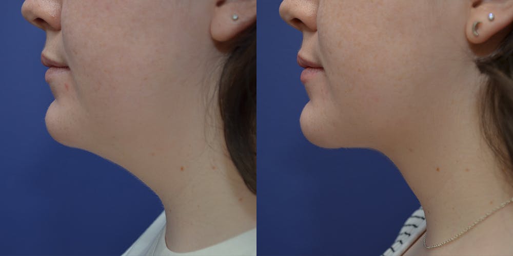Liposuction Before & After Gallery - Patient 80448945 - Image 2