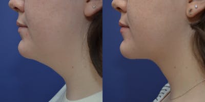 Liposuction Before & After Gallery - Patient 80448945 - Image 2